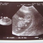 First Ultrasound at 10 Weeks